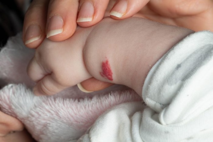 Lei institui Semana de Conscientização sobre Hemangioma e Anomalia Vascular